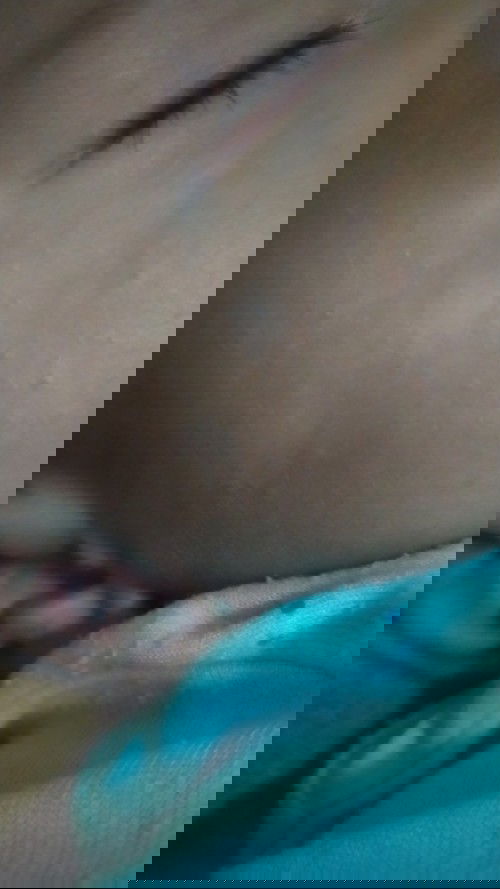 Bekas luka warna putih