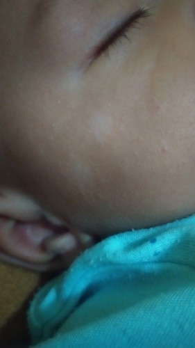 Bekas luka warna putih