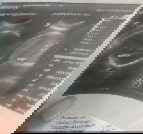 Kenapa ya bun udah 2x d usg jenis klamin nya gak kelihatan trus