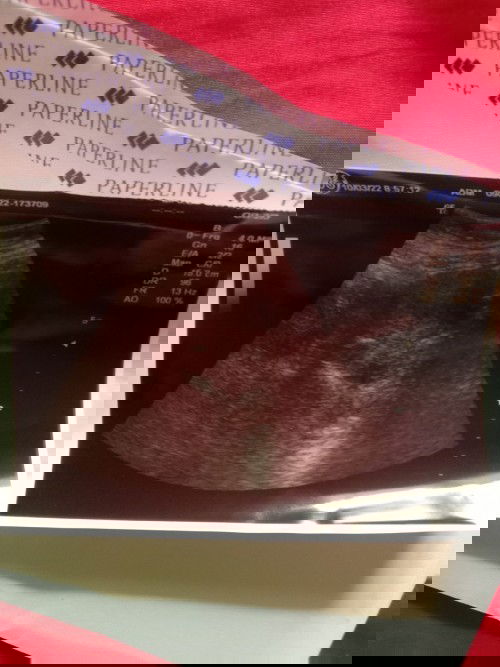 sakit perut bagian bawah kiri,