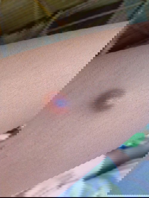 Có mom nào biết mụn này là mụn j ko ạ e bị , hơn 3 năm r mà ko mất