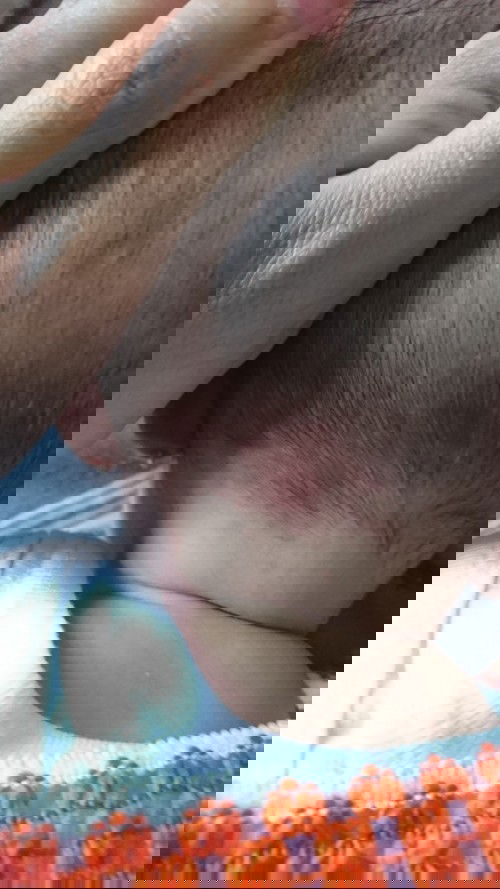 Bercak di kepala bayi