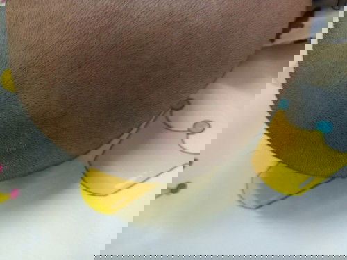 มีวิธีดูแลหนังหัวลอกยังไงบ้างคะ