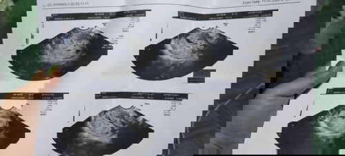 หมอบอกว่าถุงตั้งครรภ์ผิดปกติต้องเอาออกอย่างเดียว😭😭😭