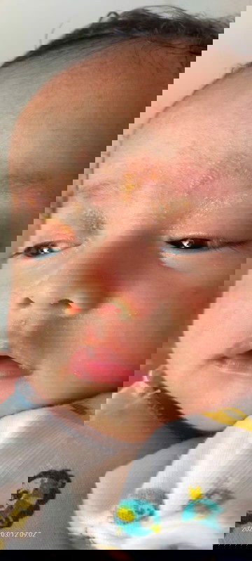 Muncul bercak kuning di muka bayi