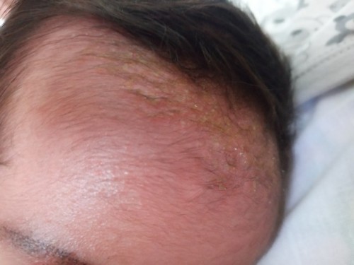 Kerak kepala bayi berbau