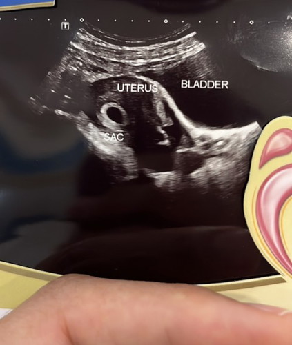 6weeks scan