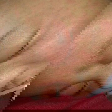 Gatal karena ulat bulu