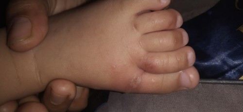 ลูกน้อยวัย6เดือน
แนะนำหน่อยค่ะ..ใช้ยาอะไรลูกคันนอนไม่ค่อยหลับค่ะ