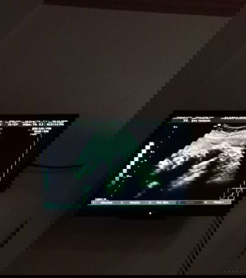 7months, suwi. May chance pa po ba na umikot?