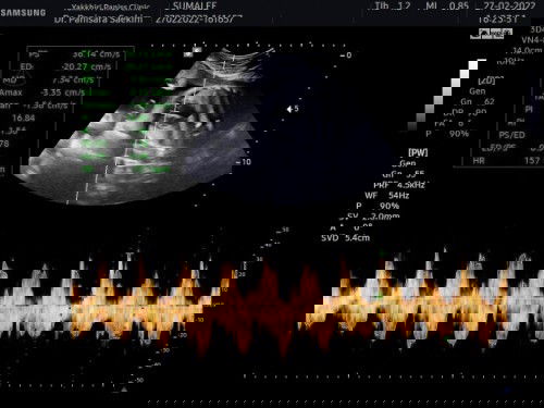 ภาวะรกเกาะต่ำ