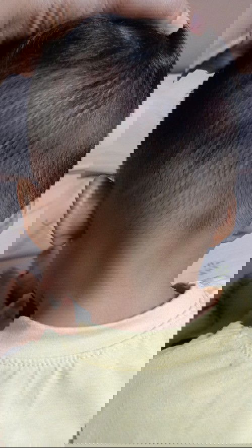 Risau ada biji2 di kepala bahagian belakang bawah anak