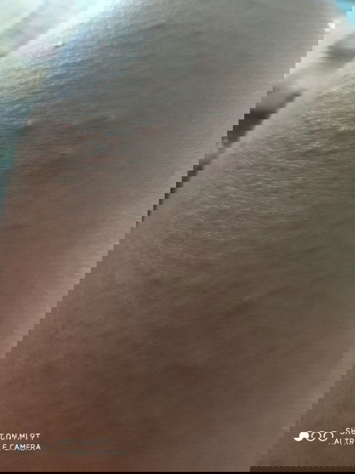 thai 35 tuần bị phát ban