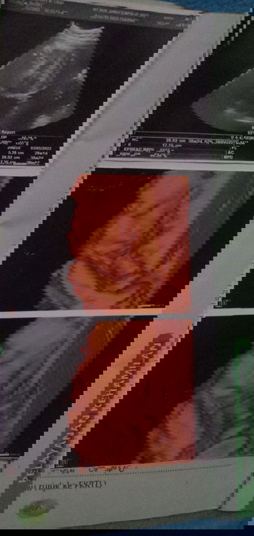 Malam bund... Mau tanya donkk.. Dibawah ini foto usg aku yg ke 29 w 3d... Tp berat nya 1500g lebih..