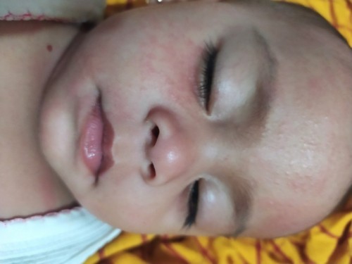 Biang keringat pada wajah bayi