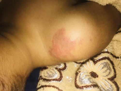 สอบถามหน่อยค่ะ ผื่นแบบนี้เกิดจากอะไร และมันคือผื่นอะไรค่ะ กลุ้มใจมากจริงๆคะ😭