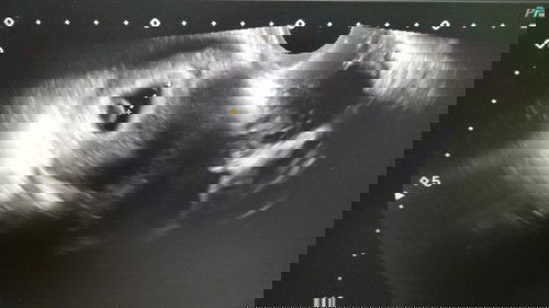 Keluar darah seketul