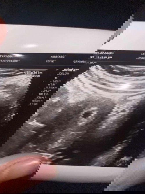 Berdarah molar @ normal@ gugur@ blighted? 