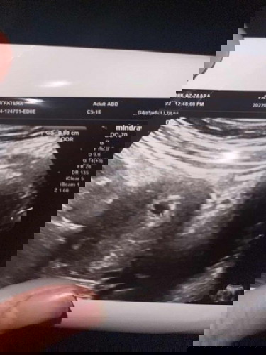 Berdarah molar @ normal@ gugur@ blighted?