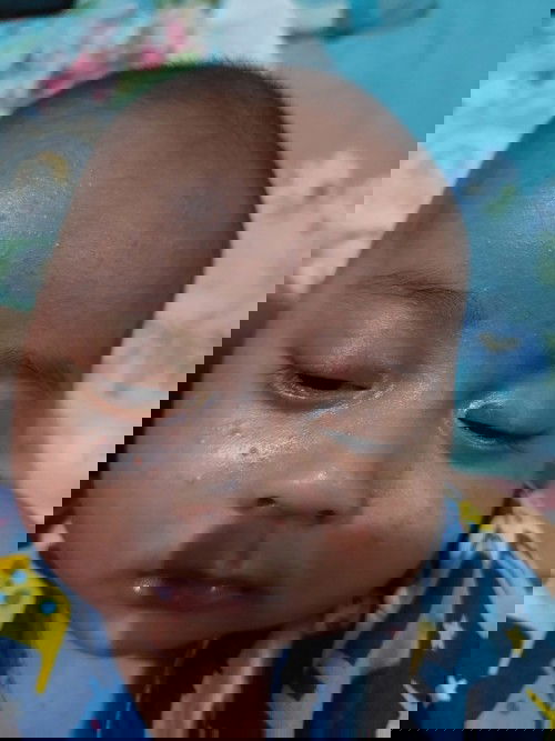 Bentol bentol merah di wajah