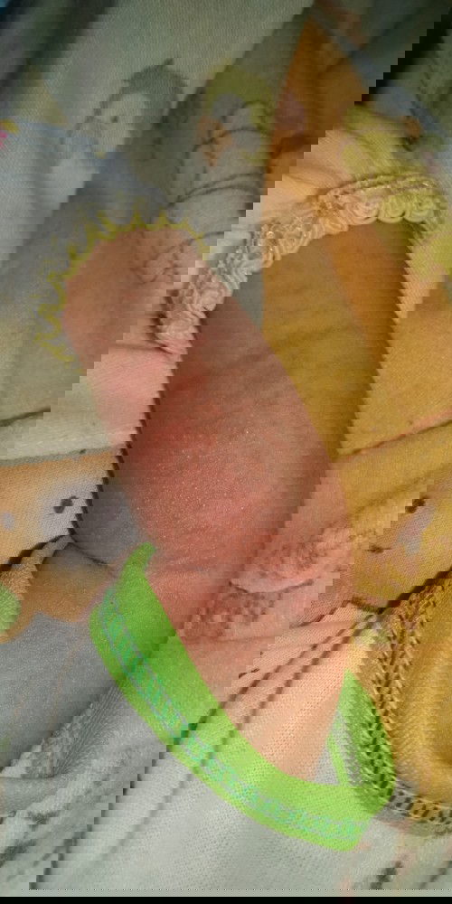 Merah merah beruntusan pada kulit bayi