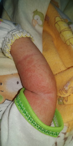 Merah merah beruntusan pada kulit bayi