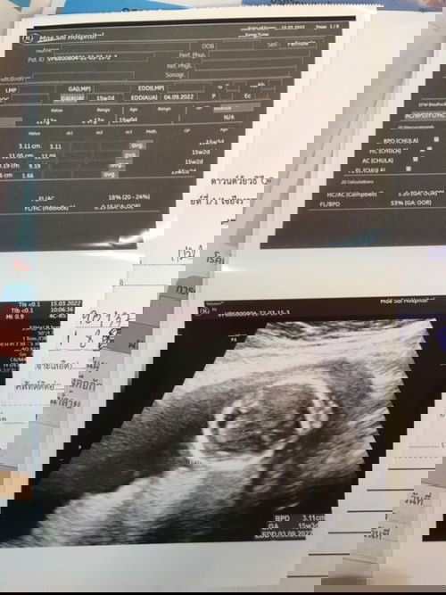 อยากทราบจังว่า น้องเป็นยังไงบ้าง แม่ดูไม่เป็น วันนี้ไปตรวจคัดกรองดาวน์มาค่ะ