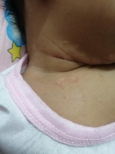Mga momshie ano po magandang gamot po dito. Meron sa batok at leeg ni baby. 1month&21 days na po sya