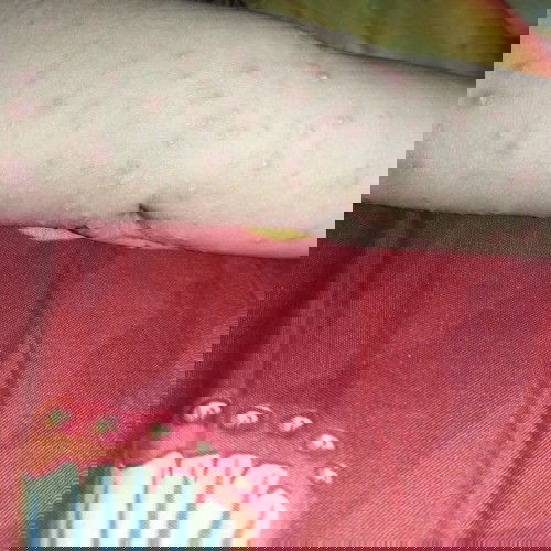 Cacar air pada anak 1 thn