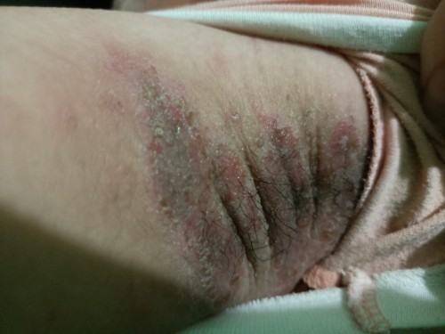 Ano po tamang gamot sa larawang sugat sa kili kili medyo masa masa siya at mapula at makati.Help po