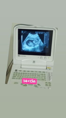 เด็กน้อย15+6วีค