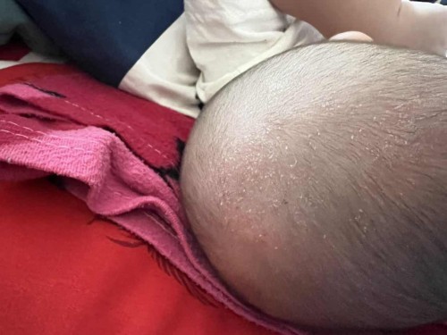 หัวเป็นสะเก็ตขาวๆ