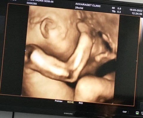 ปกติลูกในท้องกลับหัวกันตอนกี่เดือนคะ