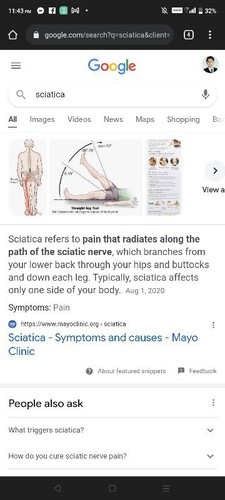 Naiipit na ugat sa likod. Nerve back pain.