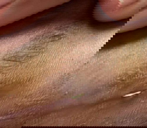 ไหมโผล่ขึ้นมาจากแผลผ่าคลอด