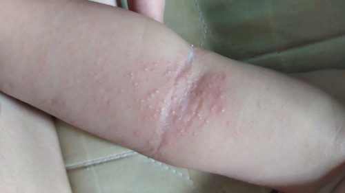 Bruntusan merah gatal di Dada,punggung dan lipatan sekitar lengan&leher?