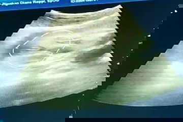 Hasil usg jk janin berbeda