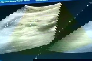 Hasil usg jk janin berbeda