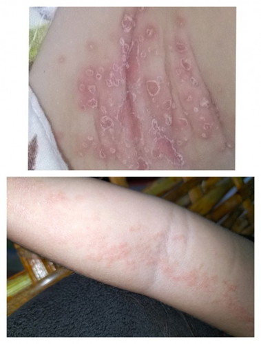 Toddler rash