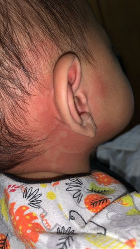 Gatal Bentol Hilang Timbul