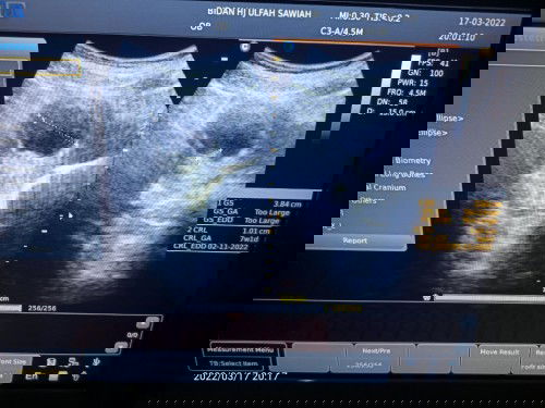 Usia kehamilan 11 Minggu pas USG dde utunya gak nampak
