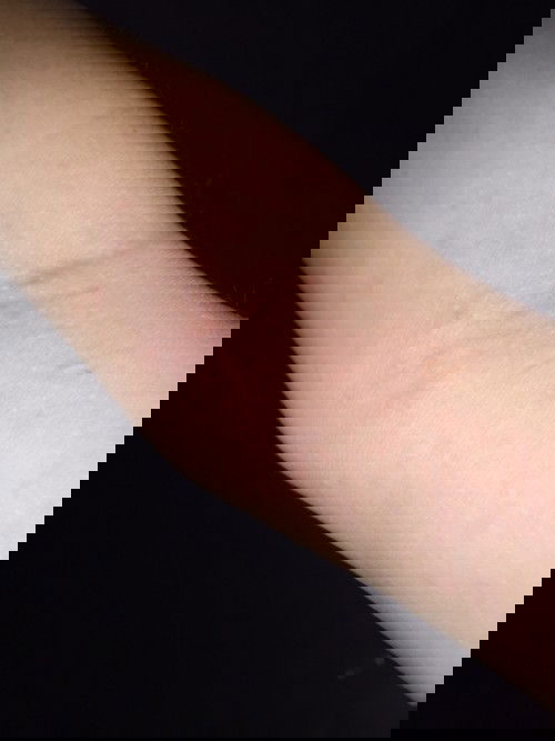 ตุ่มแบบนี้คือไรค่ะ