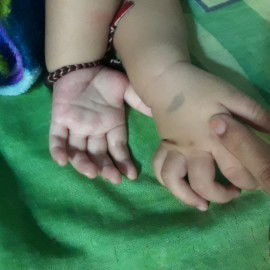 Arti tanda lahir di tangan sebelah kanan ??