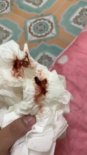 เลือดออกตอนตั้งครรภ์