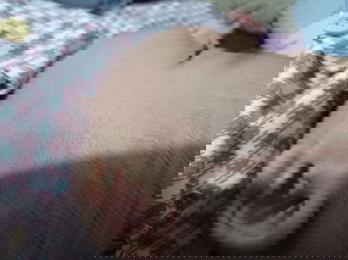 Gatal beruntusan pada bayi