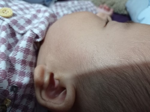 Gatal beruntusan pada bayi