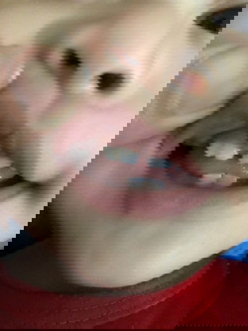 Răng sữa bị vàng