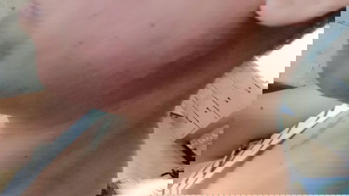 Acne during my 14 weeks pregnancy normal lang ba?