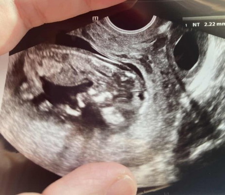 Nt Scan (Check syndrome)