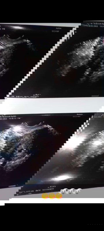 Bunda Minggu kemarin habis USG tapi yg baru kelihatan cuman kantong rahim saja bund